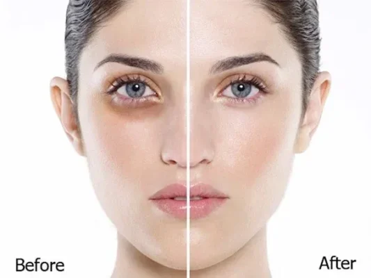 tiêm trị thâm quầng mắt 